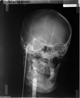 写真�B：金属ワイヤが脳に刺さったことを示唆するレントゲン写真